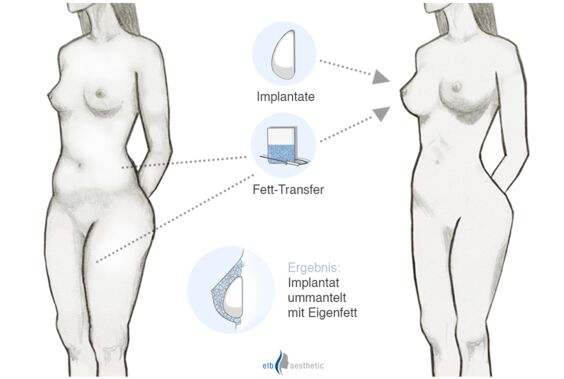 Hybrid-Brust: Implantate, ummantelt mit Eigenfett