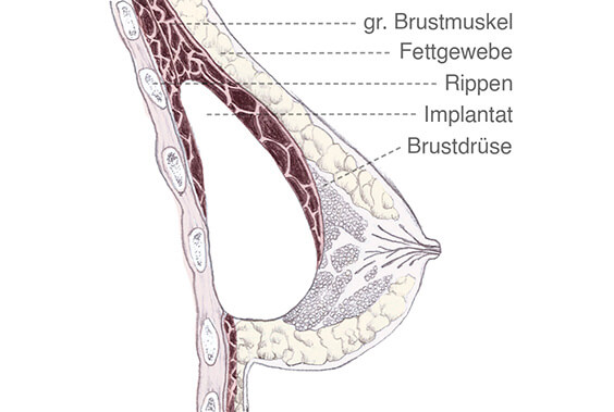 Brustvergrößerung - Implantat unter dem Muskel (subpectoral)